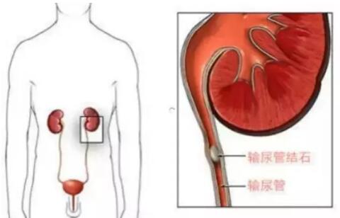 输尿管结石，到底能不能保守治疗？