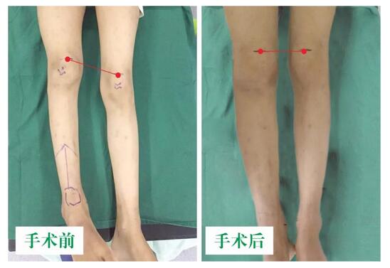 女孩坠梯右腿缩短5cm，幸得医生及时诊治恢复正常腿型